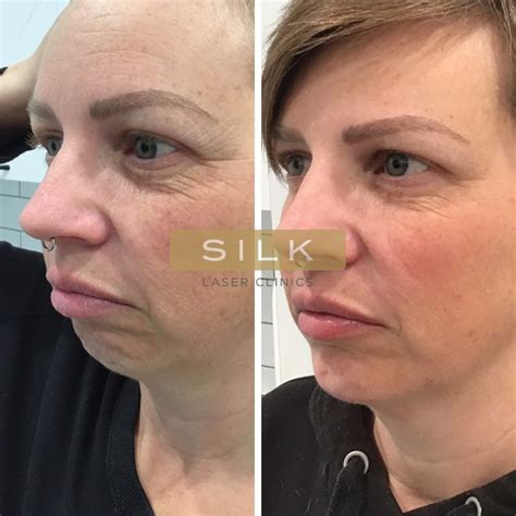 SILK Laser Clinics Skin Treatments Laser Clinics