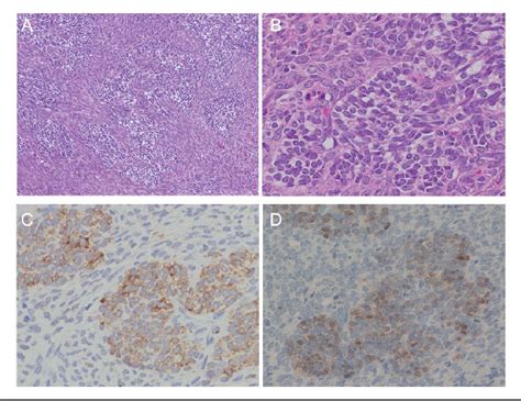 Figure 3 From Extraovarian Fibroma With Minor Sex Cord Elements A Case Report And Literature