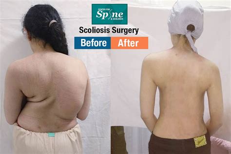 Best Spine Scoliosis Correction Surgery Specialist In India