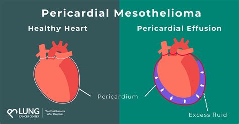 Pericardial Mesothelioma - Asbestos Rare Cancer