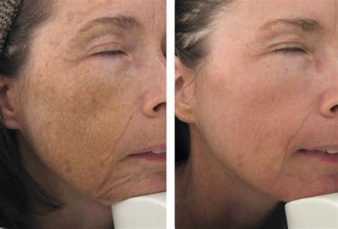 Fraxel Dual Laser Before After Serenity Medspa