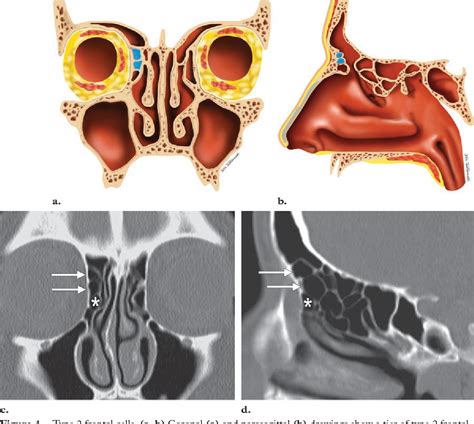 Figure From Failed Endoscopic Sinus Surgery Spectrum Of Ct Findings