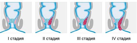 Внутренний геморрой: симптомы, лечение, причины