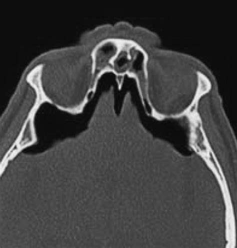 Axial CT Scan Revealing Tension Pneumocephalus Caused By A Skull Base