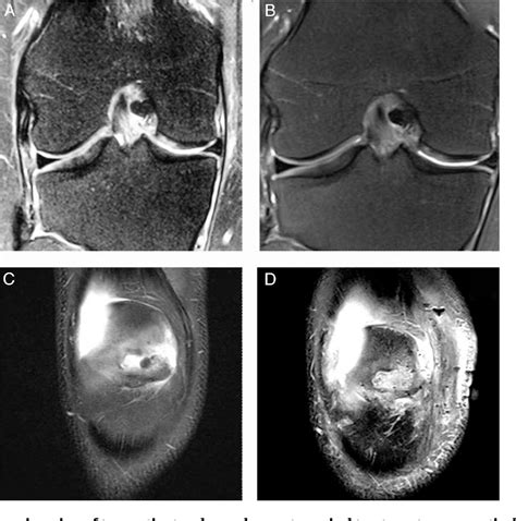 Figure 2 From Surgical Treatment Of Chondral Knee Defects Using A