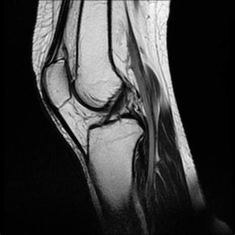 Tibial Plateau Insufficiency Fracture Image Radiopaedia Org