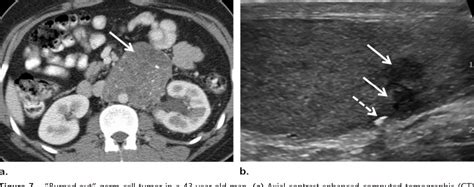 Figure 7 From Testicular Tumors What Radiologists Need To Know