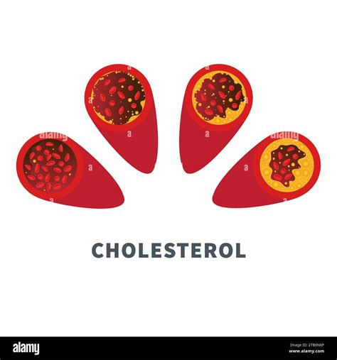 Abdominopelvic Atherosclerosis