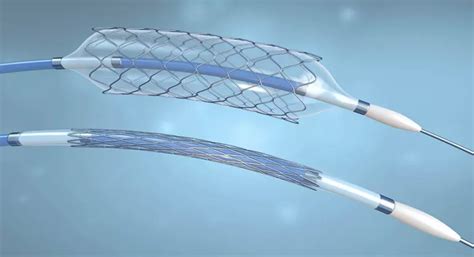 Stent Coronario Qu Es Cu Ndo Se Implanta Y Consejos