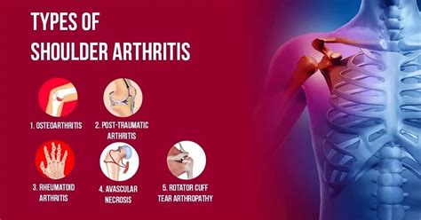 Understanding The Types Of Shoulder Arthritis And Their Symptoms