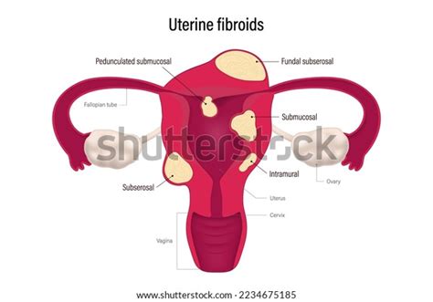 Uterine Fibroid Locations Pedunculated Submucosal Fundal Stock Vector