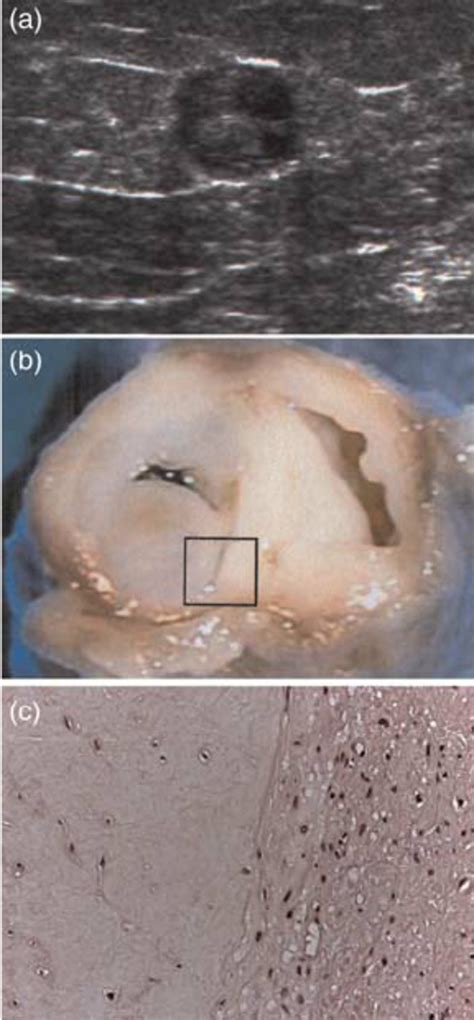 Anterior Accessory Great Saphenous Vein A Preoperatory Duplex