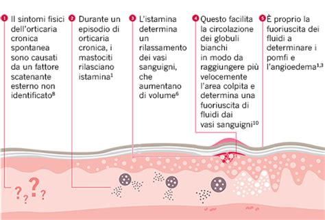 Orticaria Cronica Cause E Sintomi La Pelle Conta