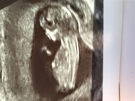 12 Week Scan Any Guesses X Mumsnet