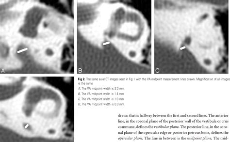 Figure 2 From When Is The Vestibular Aqueduct Enlarged A Statistical