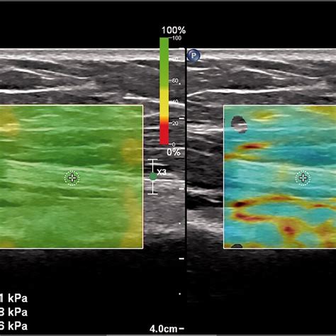 Short Axis View Of Radial Nerve Shear Wave Elastography Confidence Map