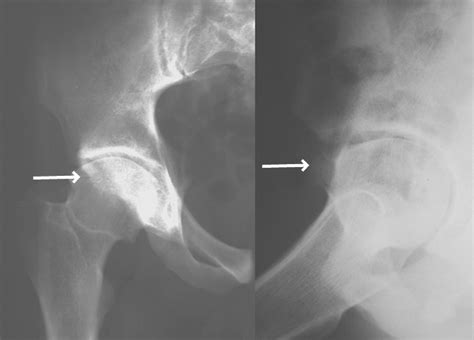 Arthroscopic Treatment Of Femoroacetabular Impingement Secondary To