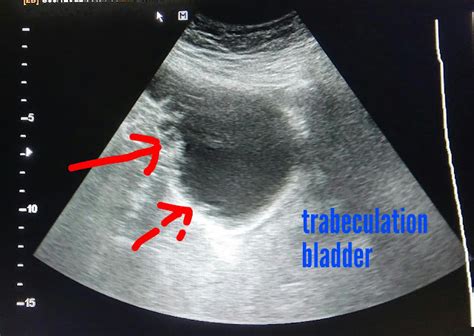 Ultrasound imaging: Urinary-bladder-trabeculation-3D-ultrasound