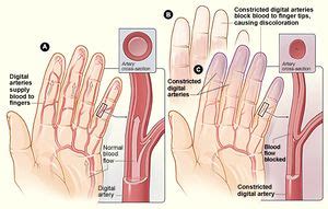 Raynaud's Phenomenon - Physiopedia