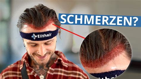 Haartransplantation Ohne Rasur Patient Teilt Seine Erfahrungen YouTube