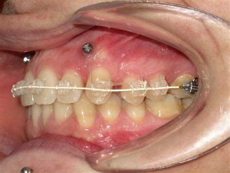 Microtornillos En Ortodoncia Para Qu Sirven Travesiortodoncia Es
