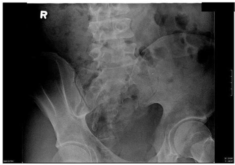 Sacroiliac Joint Dysfunction X Ray