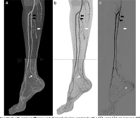 Figure 2 From Selective Intra Arterial Dual Energy Ct Angiography S Cta In Lower Extremity