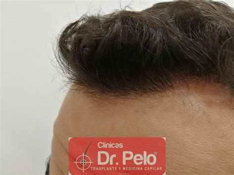 Caso 44 Injerto Capilar Con 1 835 Grafts 3 912 Pelos Dr Junior