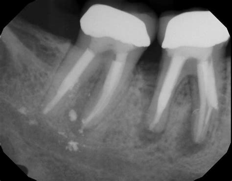 CBCT Scan For Failed Root Canal Oral Radiology Toronto