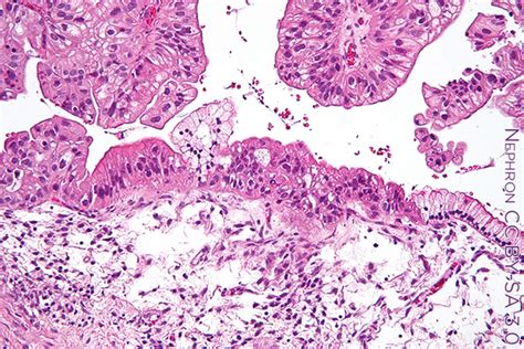 Ovarian Ca: Survival Implications of Histologic Subtype - Focus on ...