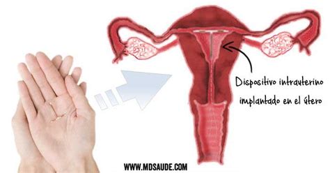 DIU de cobre y DIU Mirena Anticonceptivo intrauterino MD Saúde