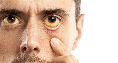 Yellow Eyes Common Causes And When To See A Doctor Eyes Yellow Mi