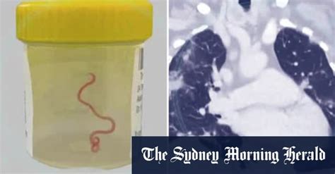 [AU] - Live worm found inside Australian woman's brain : r/SMHauto