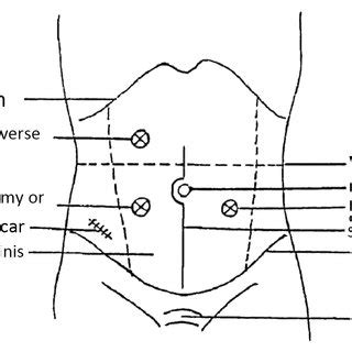 Common locations of enterostomy. | Download Scientific Diagram