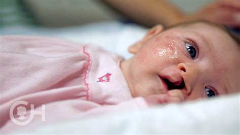 Explaining Cleft Lip and Palate (1 of 7) - YouTube