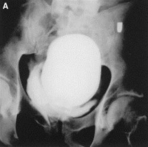 Urologic Emergencies Emergency Med Flashcards Quizlet