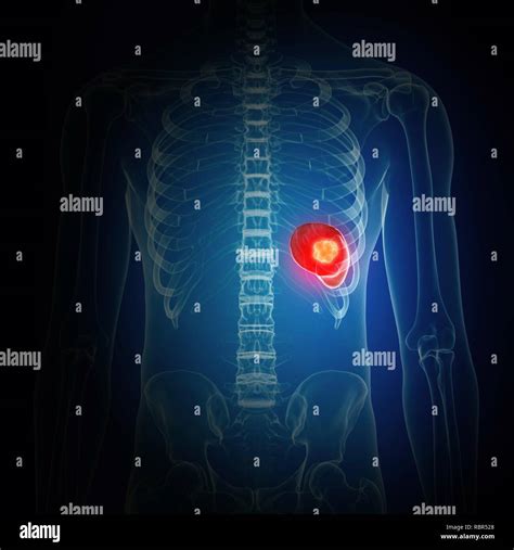 Illustration of spleen cancer Stock Photo - Alamy