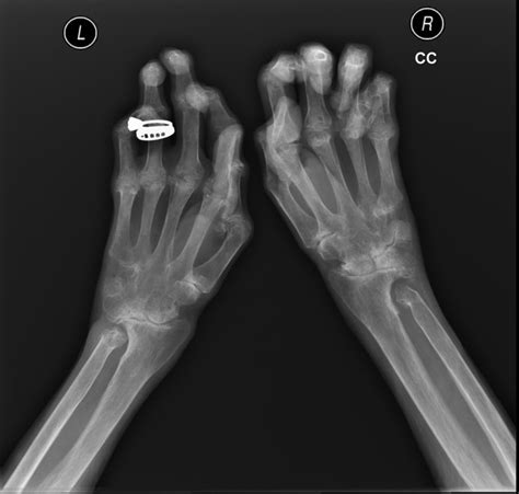 Diagnosis And Early Management Of Inflammatory Arthritis The Bmj