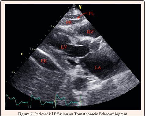 Figure 2 From Acute Pericardial Effusion From Pacemaker Lead