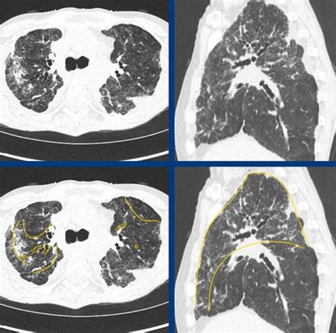 The Radiology Assistant : Pulmonary Fibrosis