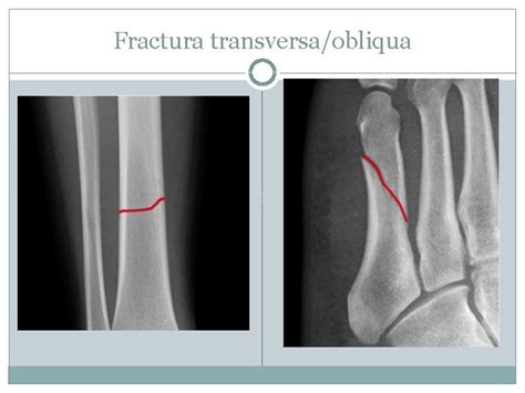 Fractures Fractura Pathologica Myeloma The Plasma Membrane Of