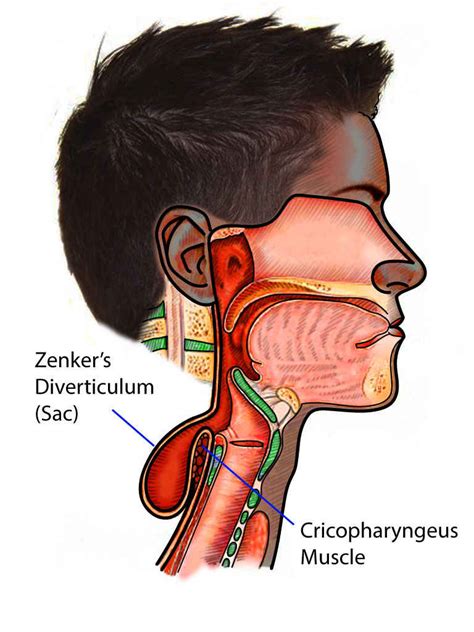 Esophageal Diverticula Statpearls Ncbi Bookshelf