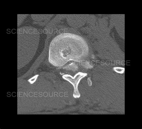 Photograph Chance Fracture Of Thoracolumbar Spine Science Source Images