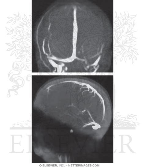 Magnetic Resonance Venography Coronal And Sagittal Views