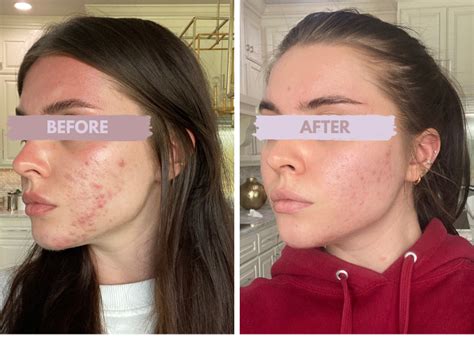 Chronic Breakouts To Clear Skin Katie Stewart Wellness Reviews