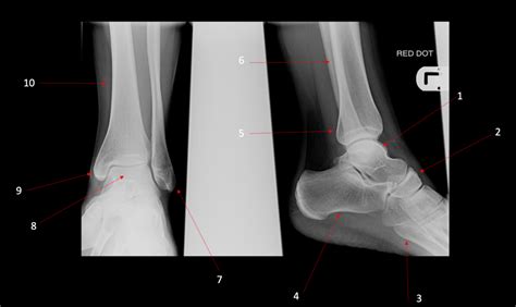 Diagram Of Ap Lateral Ankle Xray Quizlet