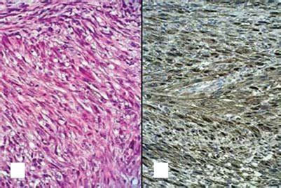 Corte Histopatol Gico A Sarcoma De Alto Grado Con Patr N Fusocelular