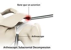 Subacromial Decompression Seattle Shoulder Impingement Bellevue