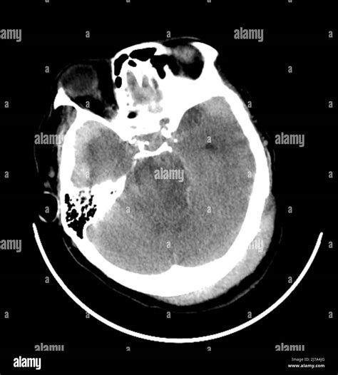 Traumatic Brain Injuries Ct Scan Stock Photo Alamy