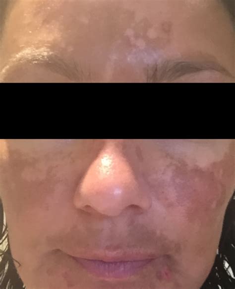 Obagi Nuderm Treatment From Staffordshire Skin And Laser Clinic